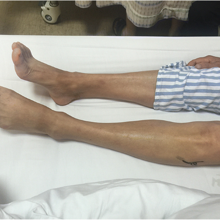 paralysis of leg muscles resulting in inability to lift the foot