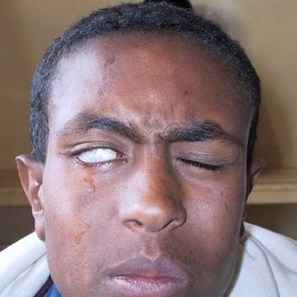 Blindness resulting from paralysis of eye muscles