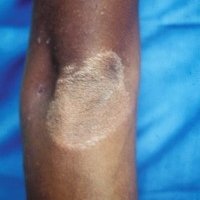 Patch of discoloured skin