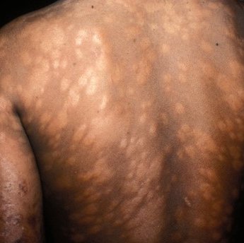 Spots of discoloured skin on a man's back